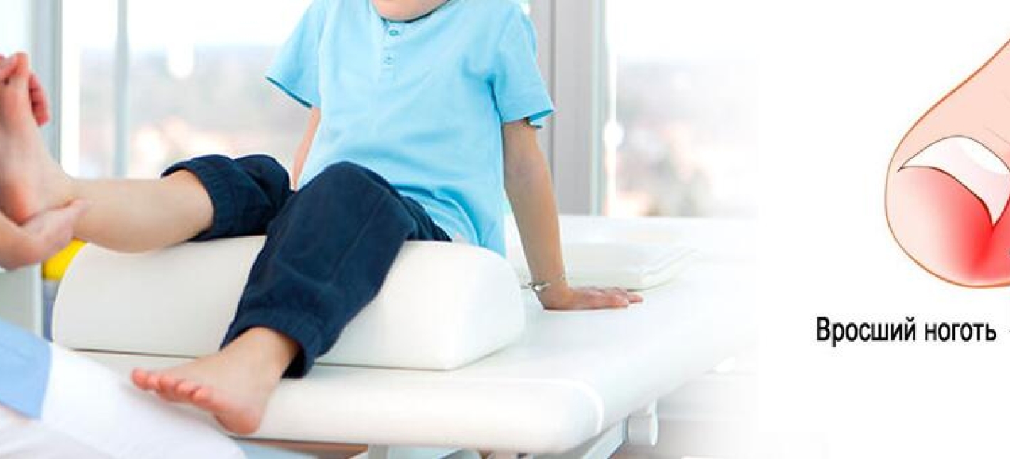 Удаление вросшего ногтя ребенку