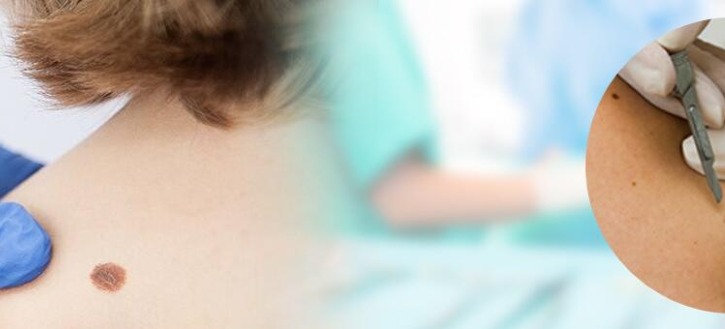 Хирургическое удаление